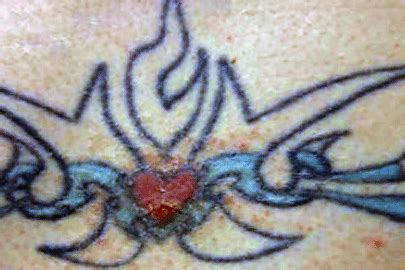 Tattoos: 7 unexpected skin reactions and what to do about them